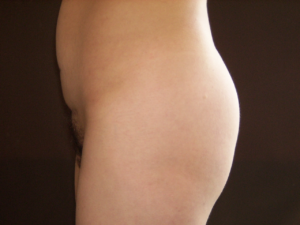 gluteoplastia-antes