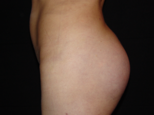 gluteoplastia-despues